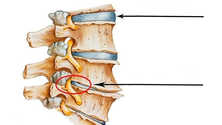 τραυματισμός της σπονδυλικής στήλης σε περίπτωση οστεοχόνδρωσης του τραχήλου της μήτρας