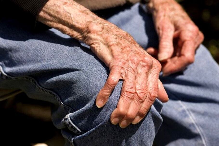 Η αρθροπάθεια είναι μια ασθένεια που σχετίζεται με την ηλικία και εμφανίζεται σε άτομα μεγαλύτερης ηλικίας
